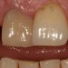 (A) Before composite veneers