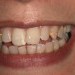 (D) Before teeth whitening
