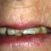 (D) Before composite veneers and dentures