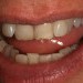 (C) Before composite veneers