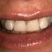 (C) After composite veneers