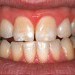 (E) Before teeth whitening